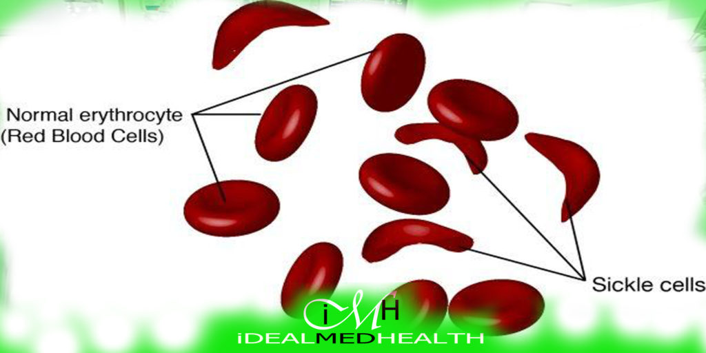 sickle cell anemia