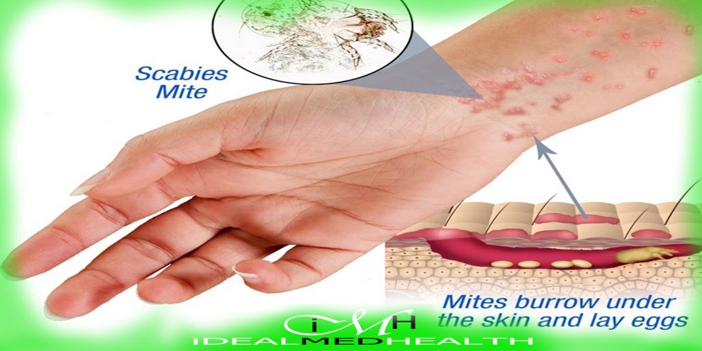 pathophysiology of scabies
