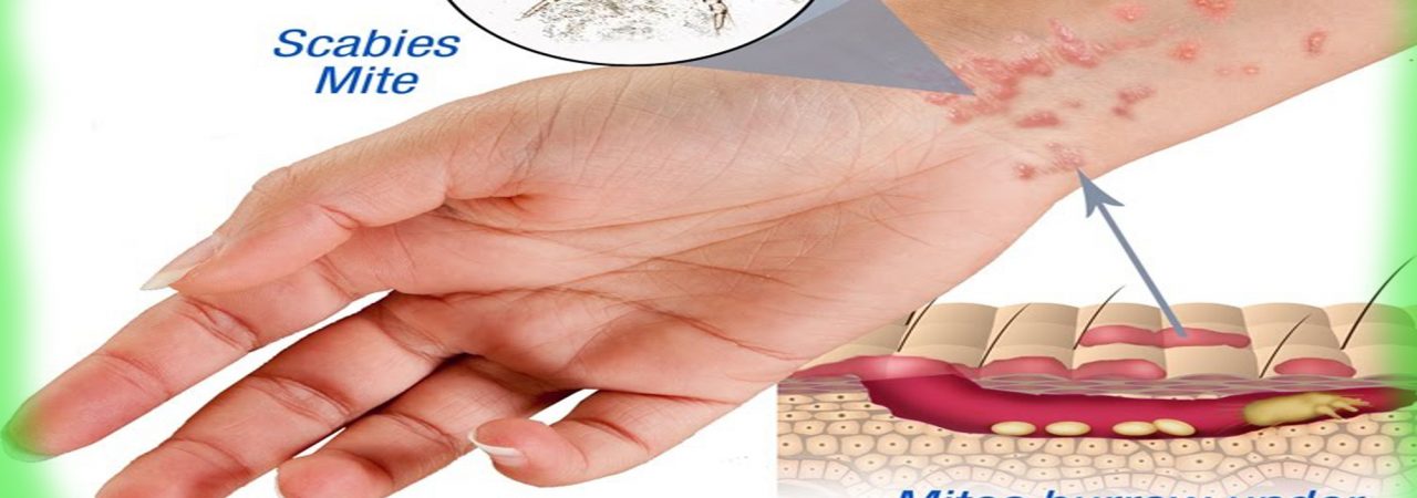 pathophysiology of scabies