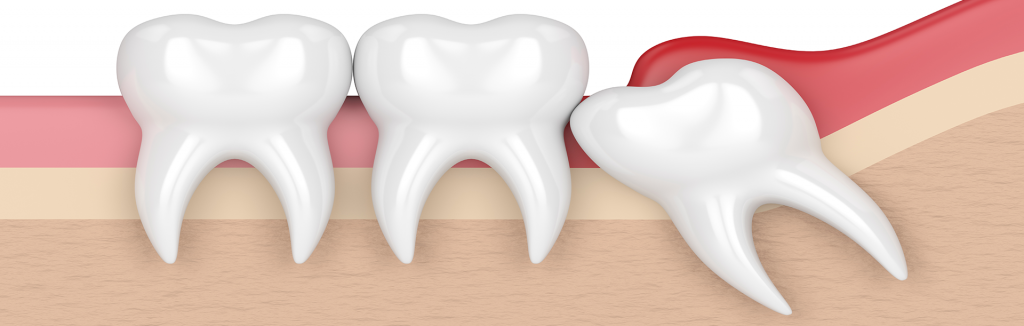 problematic wisdom teeth