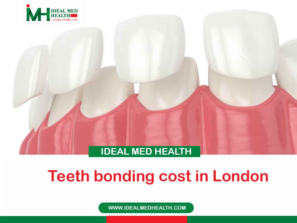 Teeth bonding cost in London idealmedhealth